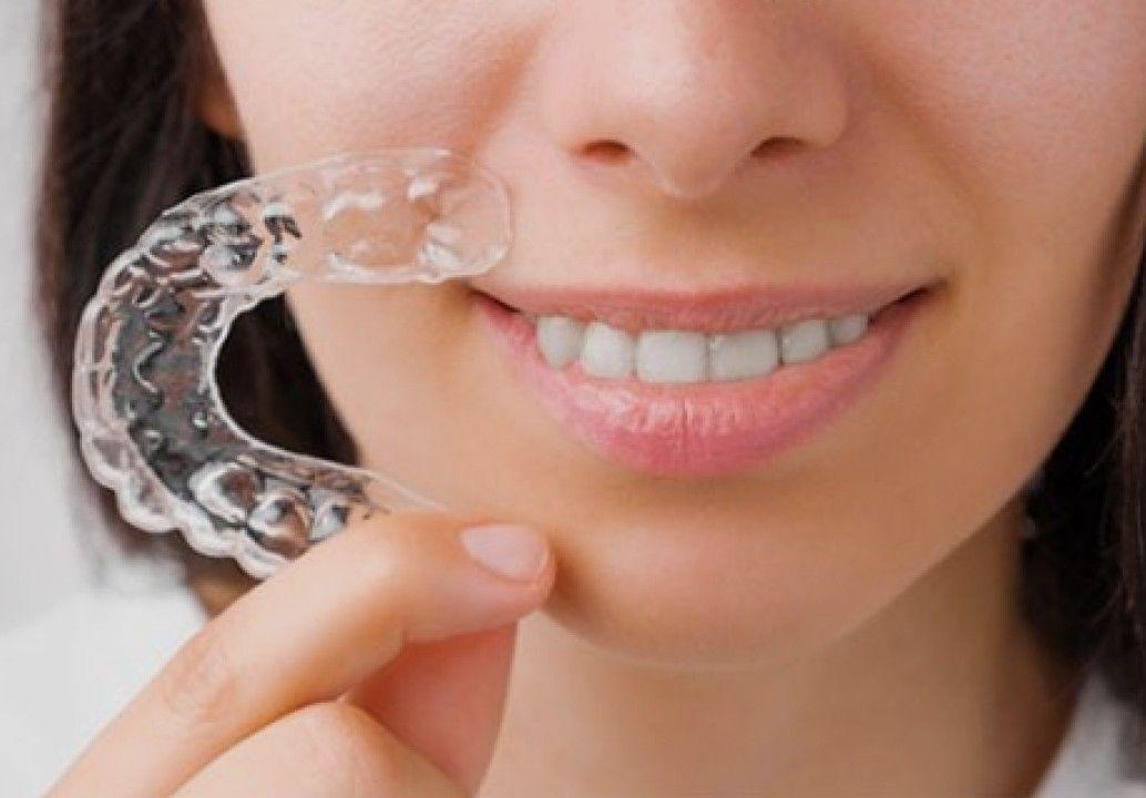 Clear Aligners